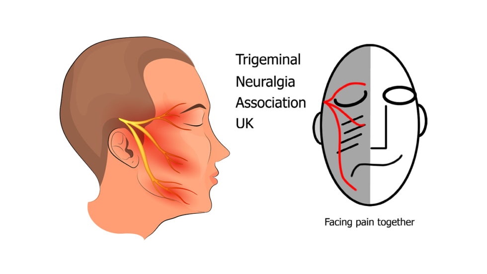 Trigeminal Neuralgia Association